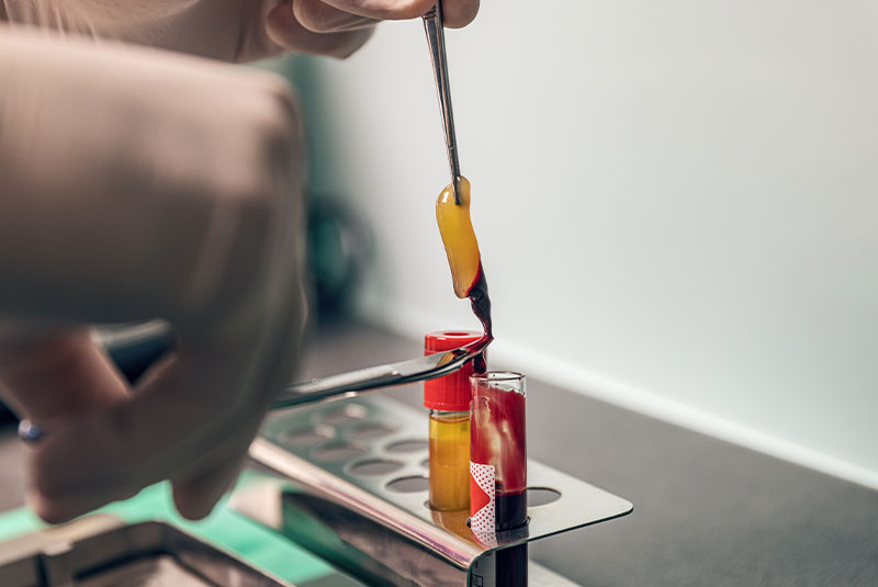 close up of platelet rich fibrin in glass tube