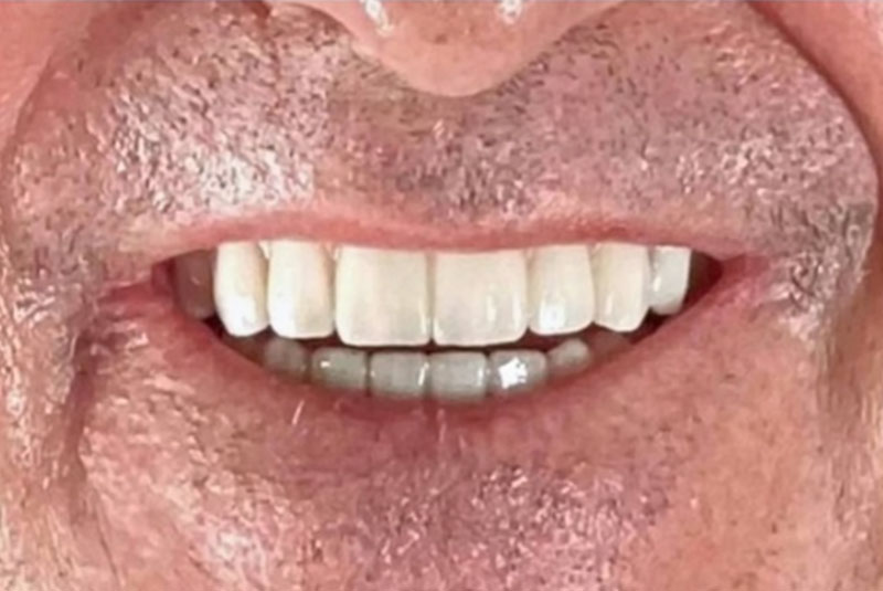 close up of before and after procedure