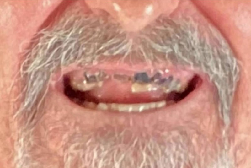 close up of before and after procedure