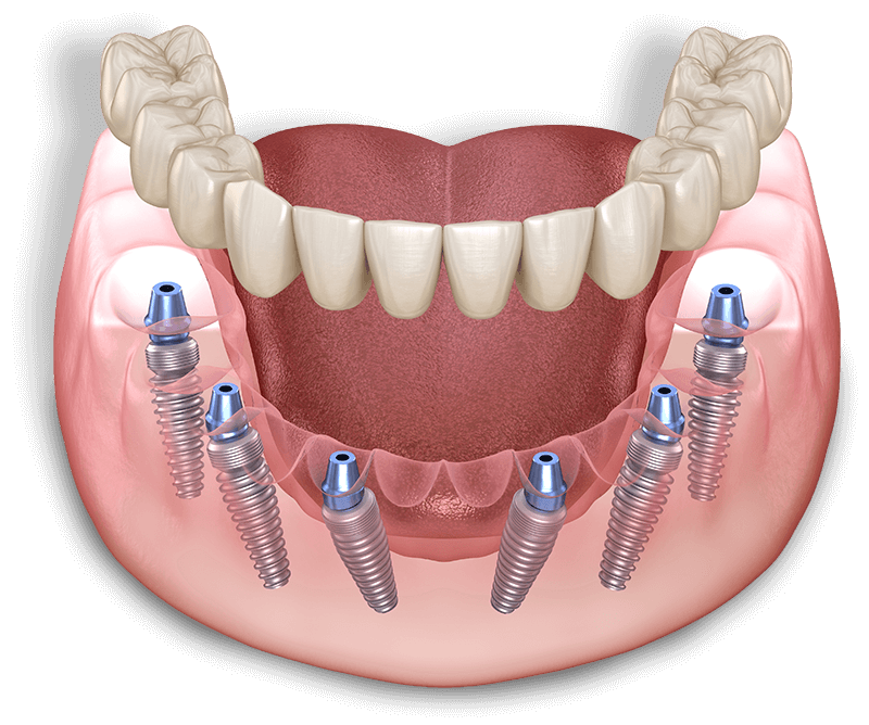 close up of full arch dental model
