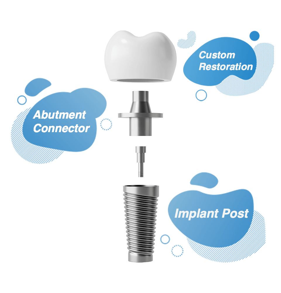 single implant info chart