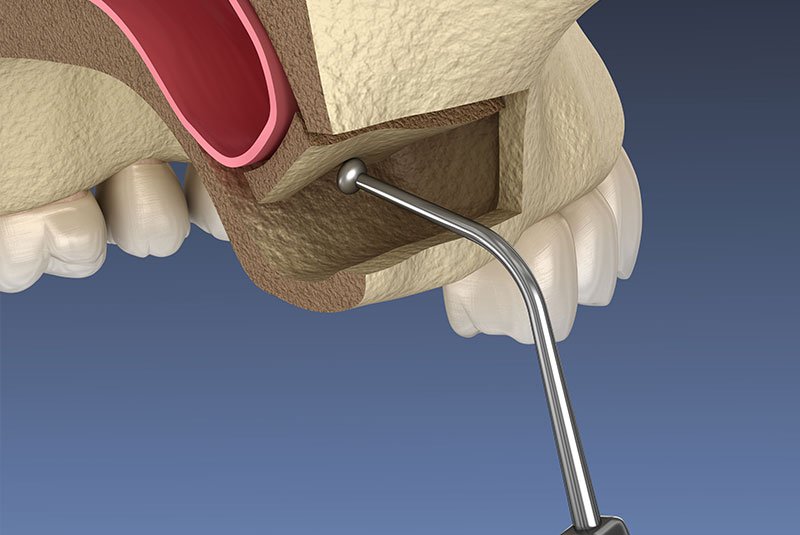 illustration of sinus lift
