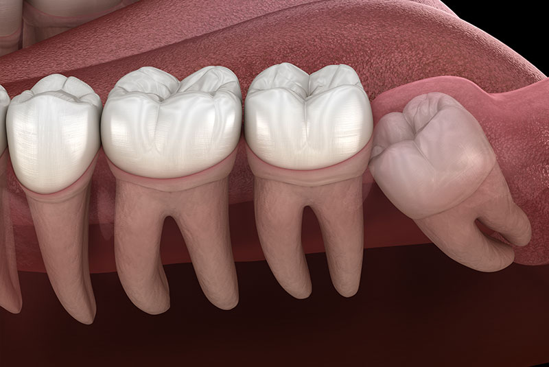illustration of wisdom tooth