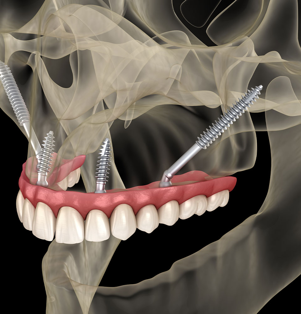 zygomatic implants